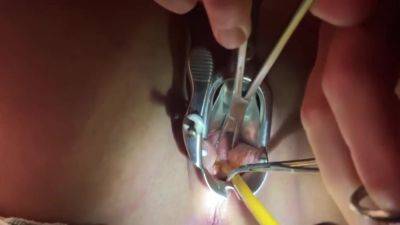 Tenaculum Grasping Cervix For Catheter 7 Min - hclips.com